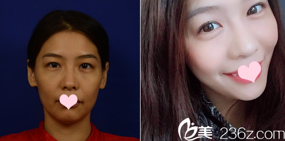 深圳米蘭柏羽陳玉面部線雕提升案例 深圳米蘭柏羽陳玉面部線雕提升案例