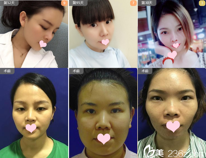 深圳米蘭柏羽劉俊醫(yī)生隆鼻案例組圖