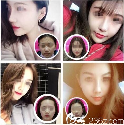 隆鼻案例 隆鼻案例