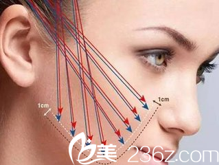 線雕是整形行業(yè)中的新型技術(shù)被推崇