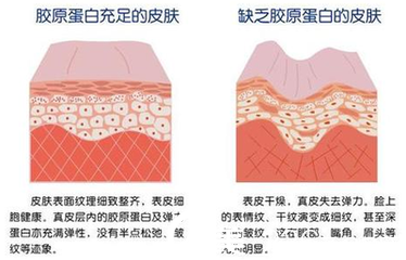 皮膚膠原蛋白充足與缺失的狀況對(duì)比