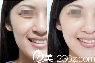 面部除皺前后對(duì)比圖