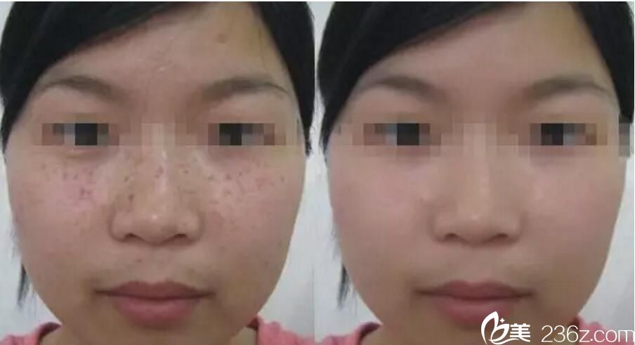 吳美珍 祛斑案例 吳美珍 祛斑案例