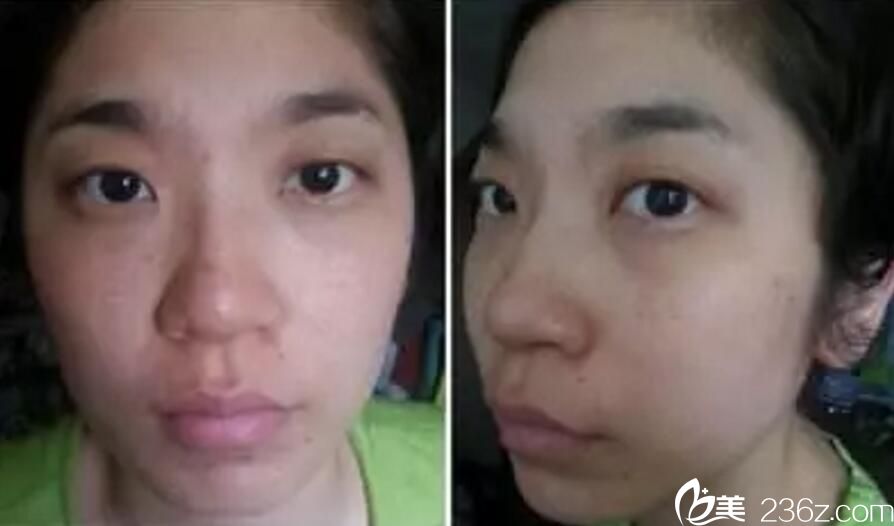 真實案例 吳美珍 激光美膚 真實案例 吳美珍 激光美膚