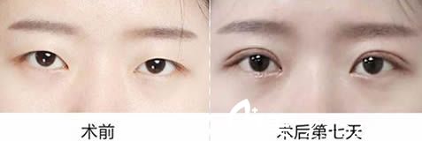 呼和浩特大韓醫(yī)院韓式雙眼皮案例