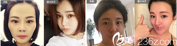 潘紅偉自體脂肪填充面部案例: 潘紅偉自體脂肪填充面部案例: