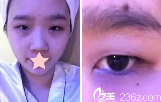 在呼市大韓做雙眼皮前的樣子 在呼市大韓做雙眼皮前的樣子