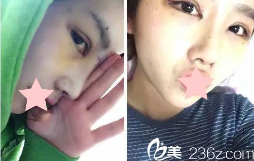 韓式雙眼皮術(shù)后7天拆線的照片 韓式雙眼皮術(shù)后7天拆線的照片