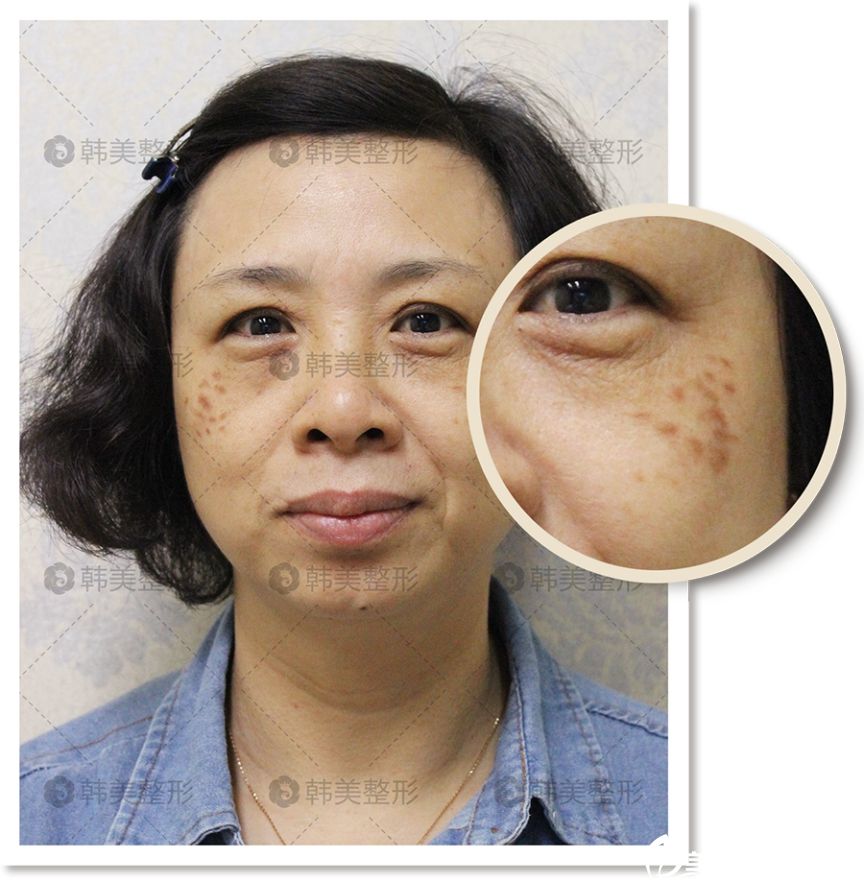 韓美吳彩霞激光去痣真人案例 韓美吳彩霞激光去痣真人案例