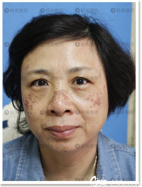 贛州激光嫩膚案例 贛州激光嫩膚案例