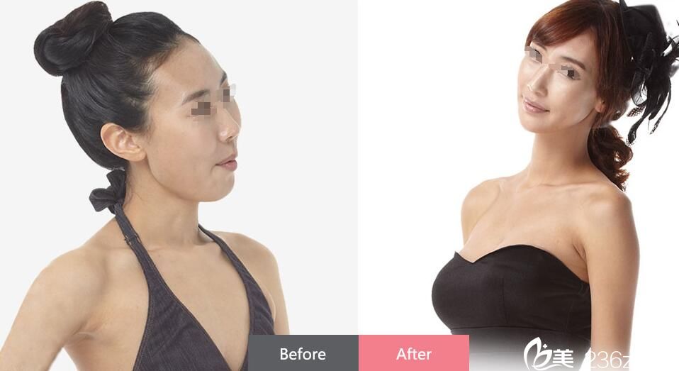 在南京韓辰隆胸前后對(duì)比案例 在南京韓辰隆胸前后對(duì)比案例