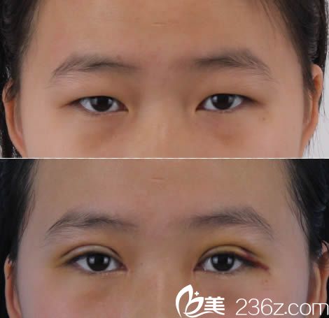 林潮醫(yī)生雙眼皮案例