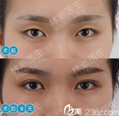 福州林潮割雙眼皮案例圖片