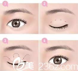 納米無痕雙眼皮就是埋線雙眼皮的一種