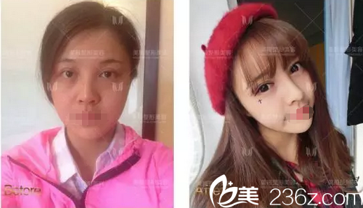 成都美極黃華隆鼻案例對比與