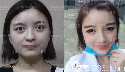 成都美極黃華全臉精雕術(shù)前術(shù)后對比