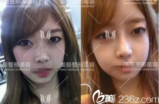 成都美極楊勇達拉斯鼻綜合案例