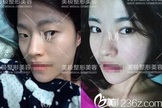 成都美極楊勇眼綜合整形對比圖