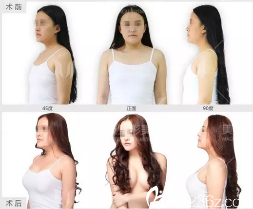 成都美極楊勇3D豐胸整形案例