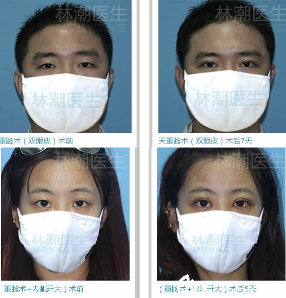 福州林潮雙眼皮案例