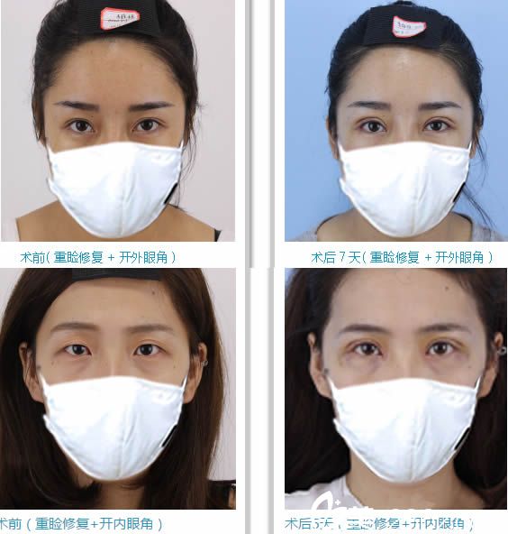福州林潮醫(yī)生雙眼皮失敗修復前后對比照