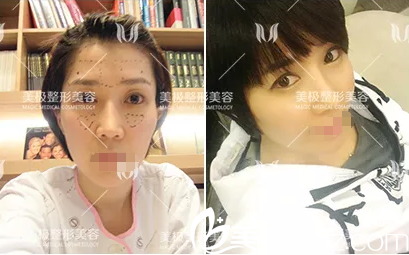 成都美極面部年輕化案例 成都美極面部年輕化案例