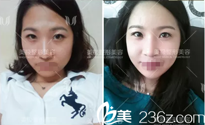 石曉軍玻尿酸填充面部+線雕提升案例 石曉軍玻尿酸填充面部+線雕提升案例