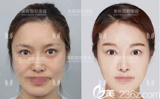 石曉軍面部填充+V臉注射案例 石曉軍面部填充+V臉注射案例