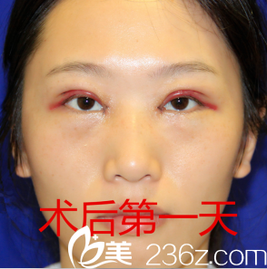 割完雙眼皮天恢復(fù)情況 割完雙眼皮天恢復(fù)情況