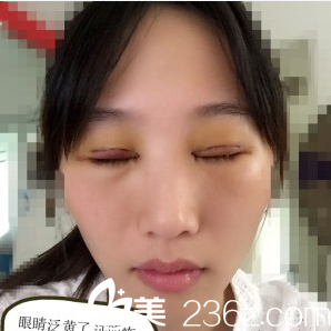 在深圳米蘭柏羽做完雙眼皮第二天閉眼效果 在深圳米蘭柏羽做完雙眼皮第二天閉眼效果