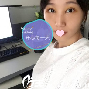 雙眼皮第三天工作照 雙眼皮第三天工作照