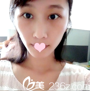 找朱武根主任做雙眼皮第7天 找朱武根主任做雙眼皮第7天