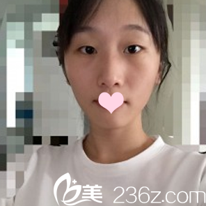 雙眼皮術(shù)前照 雙眼皮術(shù)前照