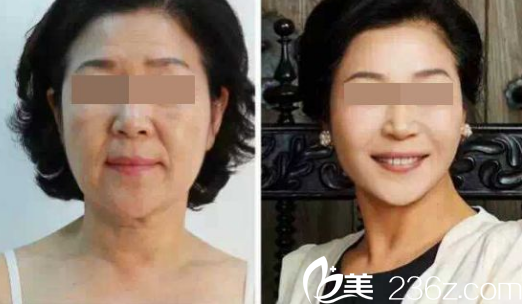 西安美萊醫(yī)學(xué)美容醫(yī)院真人案例