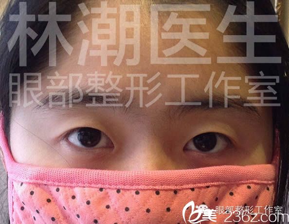 做韓式雙眼皮和開眼角術(shù)前的樣子 做韓式雙眼皮和開眼角術(shù)前的樣子