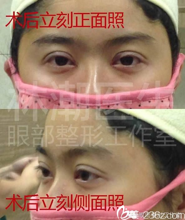 林潮院長做完雙眼皮術(shù)后即刻效果 林潮院長做完雙眼皮術(shù)后即刻效果