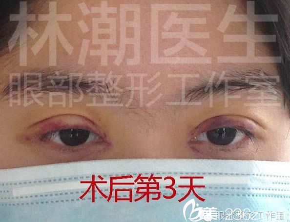 韓式雙眼皮術(shù)后3天的照片 韓式雙眼皮術(shù)后3天的照片