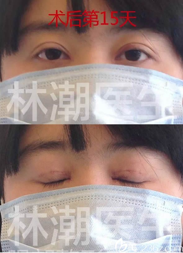 做完雙眼皮和開眼角術(shù)后15天痕跡已經(jīng)不明顯了 做完雙眼皮和開眼角術(shù)后15天痕跡已經(jīng)不明顯了