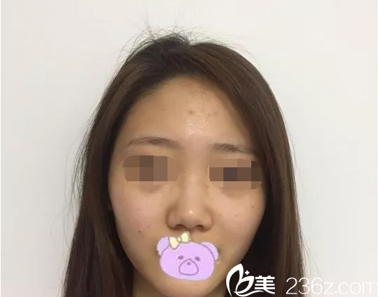 在韓國(guó)will做鼻整形之前 在韓國(guó)will做鼻整形之前