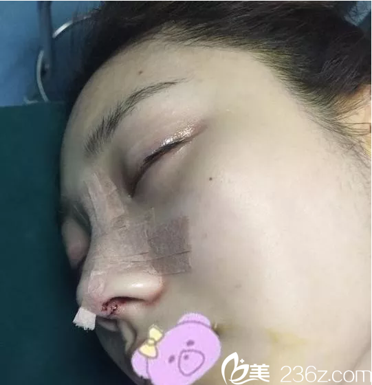 鼻綜合當(dāng)天 鼻綜合當(dāng)天