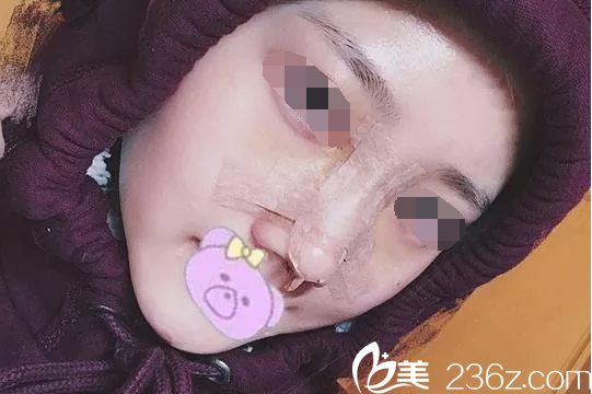 鼻綜合手術(shù)后第3天 鼻綜合手術(shù)后第3天