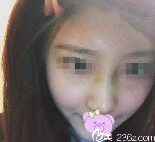 韓國(guó)will醫(yī)院鼻綜合手術(shù)后第7天 韓國(guó)will醫(yī)院鼻綜合手術(shù)后第7天