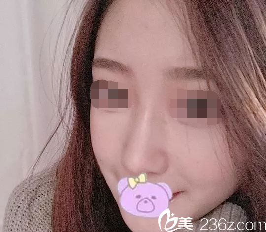 隆鼻后鼻子恢復(fù)效果 隆鼻后鼻子恢復(fù)效果