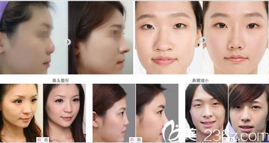 綜合隆鼻案例_<!--<i data=20240703-sp></i>-->明