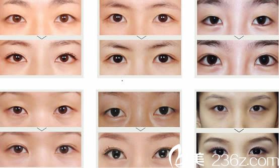 YC媚眼術(shù)雙眼皮案例_<!--<i data=20240703-sp></i>-->明院長