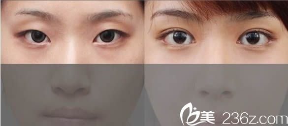 雙眼皮案例效果圖