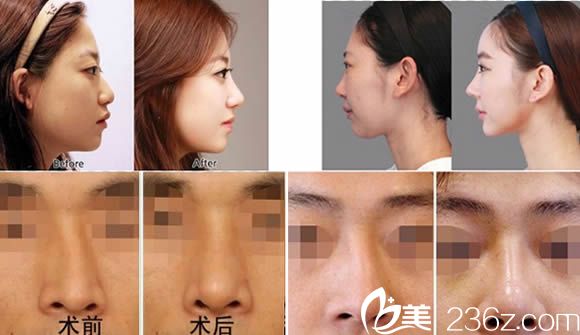 假體隆鼻和歪鼻矯正前后對(duì)比案例