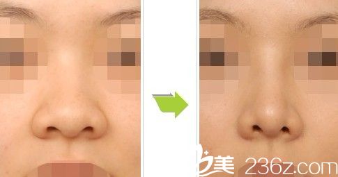 鼻部整形前后對比