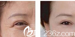 北京煤醫(yī)整形眼部除皺<span style=