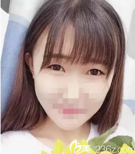 做雙眼皮術(shù)前的樣子 做雙眼皮術(shù)前的樣子